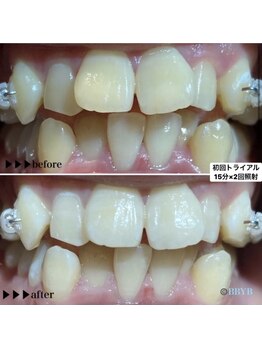 ビーバイビー(BBYB)/セルフホワイトニング15分x2回