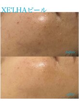 プレジール(Plaisir)/韓国人気No. 1 XE'LHAセラピール