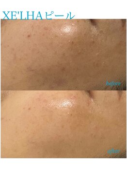 プレジール(Plaisir)/韓国人気No. 1 XE'LHAセラピール