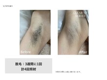 フェレザ 新潟(Felleza)/全身どこでも自由に照射OK