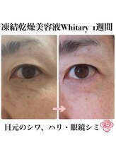 ケンビラク(Kenbiraku 健美楽)/目元のシワ・ハリ・眼鏡シミ　