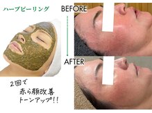 キレイベース 銀座店(KIREI BASE)/ハーブピーリング　2回での変化