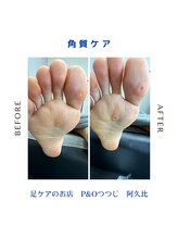 ピーアンドオー(P&O)/角質ケア