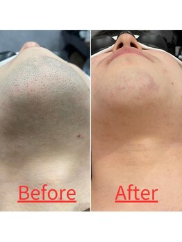 トミー(TOMMY)/Before＆After