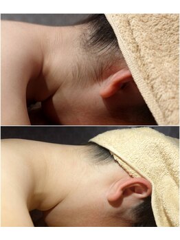 キラベル 平塚店(KiraBelle)/平塚/うなじ美肌ケア襟足脱毛