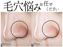 スポット 薬院駅前店(SPOT)/#毛穴洗浄 #黒毛穴 #ニキビケア