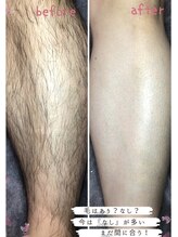 チャーム(CHARM∞)/男性の脱毛