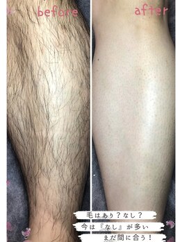 チャーム(CHARM∞)/男性の脱毛