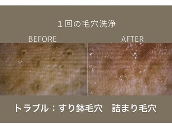 ステラ(Stella)/毛穴トラブル