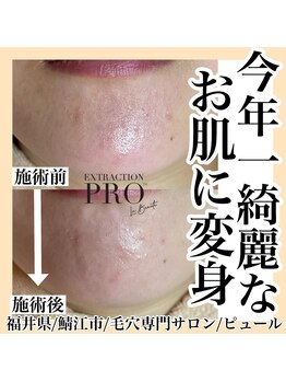 ピュール 鯖江店(PUR)/毛穴/毛穴ケア/毛穴洗浄