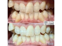 ビーバイビー(BBYB)/セルフホワイトニング初回体験