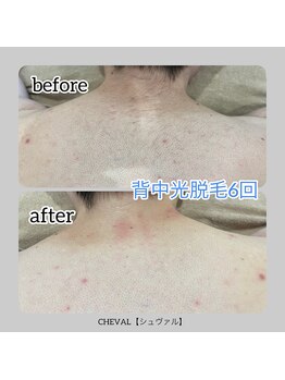 シュバル(CHEVAL)/メンズ背中脱毛6回