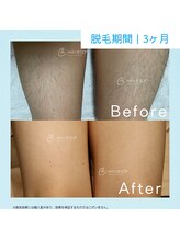 メンズクリア 熊谷ティアラ21店/【メンズクリア】お客様の施術例