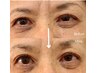 【瞼の下がり/眼窩脂肪/たるみの改善に】プラズマシャワー80分　ネックケア込
