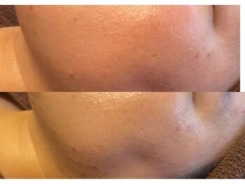 ルアーナ(Luana)/赤み鎮静 ハーブピーリング