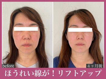 アクアビー(AQUA-B)/