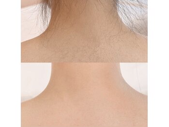 チュルリ 新町店(Chururi)/うなじ広範囲ワックス脱毛