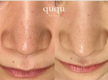 クク(ququ)/毛穴ケア