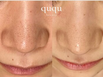 クク(ququ)/毛穴ケア