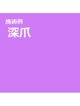 スマートリフト 五反田 大崎店(SMART LIFT)/【深爪改善】ビフォーアフター