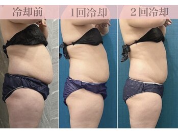 ブランシュムーニー(BRANCHE MOONY)/2カップ施術