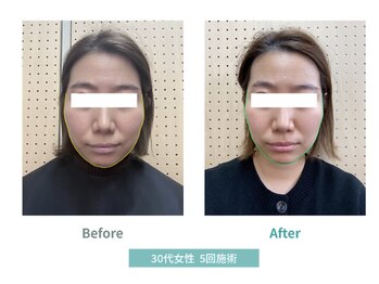 モカラ(MOKARA)/水光ジェットでリフトアップ効果