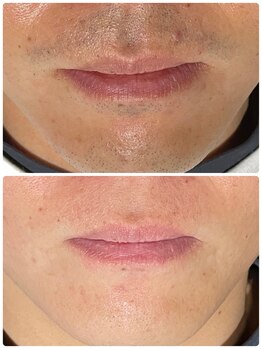 エスケア(S-CARE)/当店人気No.1メンズヒゲ脱毛！！