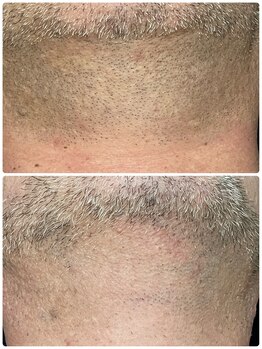 ミンア(Min-a)/光脱毛【男性ヒゲ】50代の方
