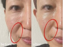 エピリス(Epiliss)/ほうれい線ビフォーアフター