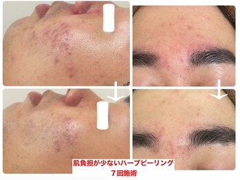 フェイシャルエステ エムズルーム(M's room)/諦めない！繰り返すニキビ予防