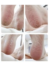 リゼランアンドコー 福島鎌田店(LIZERA&Co)/かかとガサガサさようなら~♪