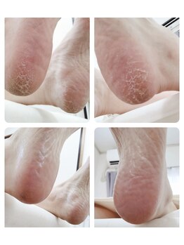 リゼランアンドコー 福島鎌田店(LIZERA&Co)/かかとガサガサさようなら~♪