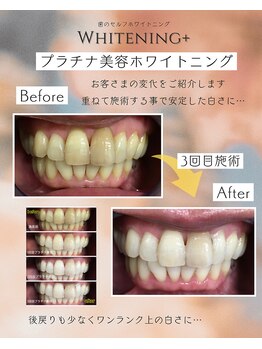 ホワイトニングプラス(Whitening+)/安定してメンテナンスへ