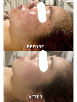 ソラ(Sola)/ニキビケア