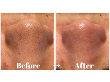 カラーリリー アンド ユン(Calla lily & yun)/毛穴の黒ずみ・詰まりを改善