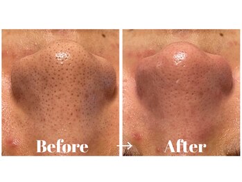 カラーリリー アンド ユン(Calla lily & yun)/毛穴の黒ずみ・詰まりを改善