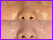 ハーブピーリング 名古屋/毛穴お黒ずみが目立ちづらく！！