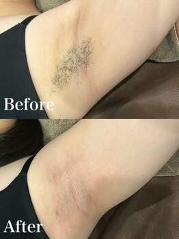 ジョエルワックス 沖縄那覇店(JOELLE WAX)/ワキの自己処理の負担軽減！！