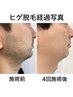 【8月限定!先着10名様】メンズヒゲ脱毛モニター (首除く5パーツ)