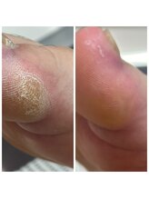 ドクターネイル爪革命 十条店/たこケア