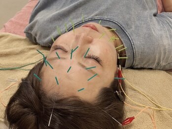 アラシ(Arashi)の写真/【とにかく上げる美顔鍼】お顔の内部からアプローチし鍼で筋膜を引き上げリフトアップ★根本原因から改善！