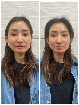 長寿鍼灸院 長寿整骨院/ハリネズミ女優美容鍼効果★