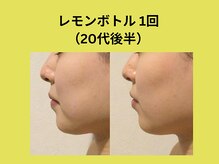 アユアランリンク 錦糸町店/レモンボトル1回