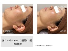 キャンアイドレッシー 東鷲宮店/顔脱毛　ｏｒ　光フェイシャル
