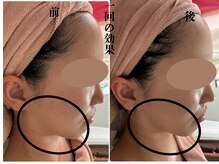 カリアンヌ/小顔/リフトアップ/透明感/毛穴