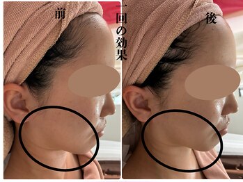 カリアンヌ/小顔/リフトアップ/透明感/毛穴