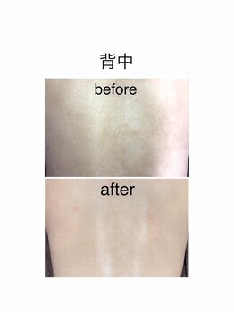 アオドットアール(Ao.r)の写真/【美肌になれる全身脱毛☆】スピード脱毛で美肌をGET♪産毛・金髪・太い毛・かたい毛対応◎