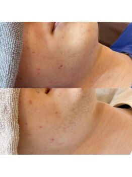 エピ リブレ(8epi.Libre)/ビフォーアフター