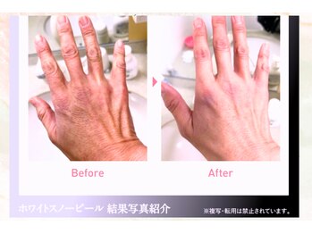 プラチナサロン 六本木/#六本木　美白　ピーリング