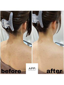 アプ(APP.)/江東区顔そり/女性顔そり/毛穴